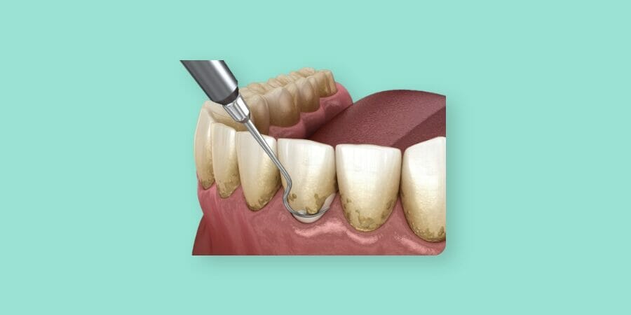 Periodontitis θεραπεία περιοδοντίτιδας