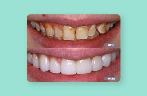 Veneers Veneers